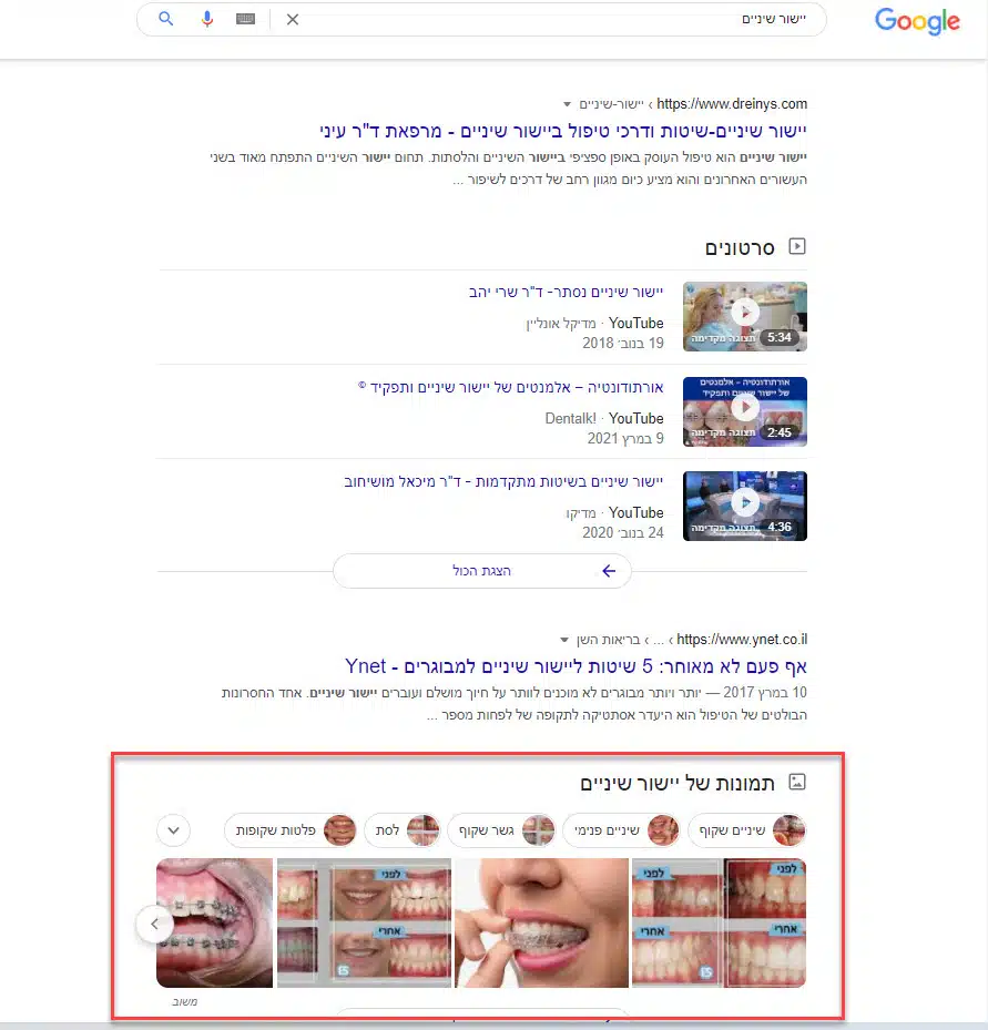 תמונות של יישור שיניים בחיפוש גוגל